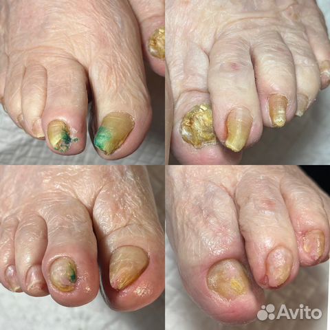 Подолог, медицинский педикюр