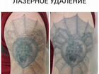 Лазерное удаление татуажа и тату объявление продам